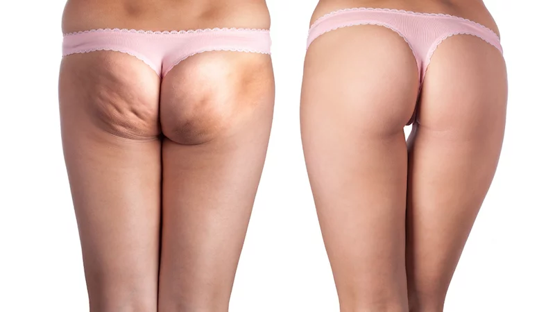 Why Does My Cellulite Hurt and How to Get Rid of It, by NutritionNerd